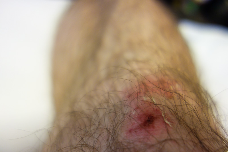 Visiting 9 cities in Japan - Oct and Nov 2016 - Heres my knee. The sore part is not where the skin is missing, its on the side. Must have bruised it except I dont bruise. It does not hurt when walki